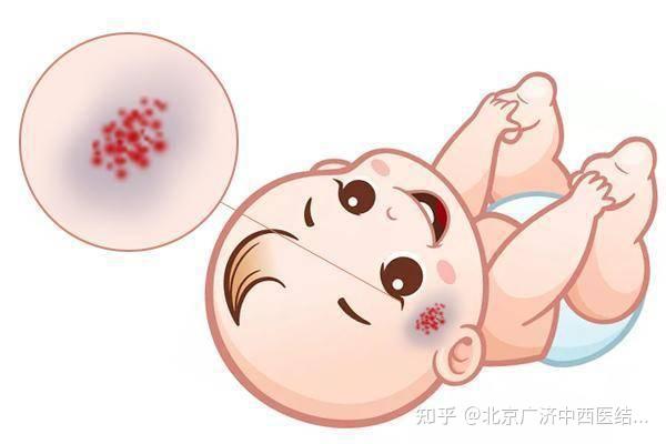 给家长讲讲——婴幼儿血管瘤 - 知乎