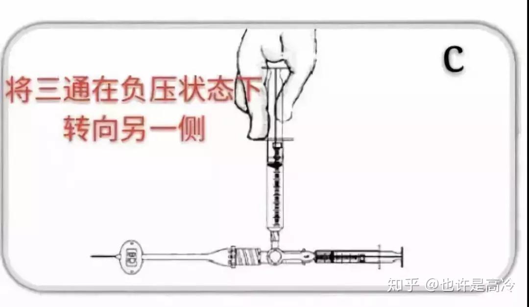 10万单位尿激酶用20ml生理盐水稀释(5000单位/ml),用20ml注射器抽1ml