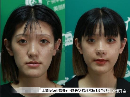 下面一起来参考两个正颌的案例