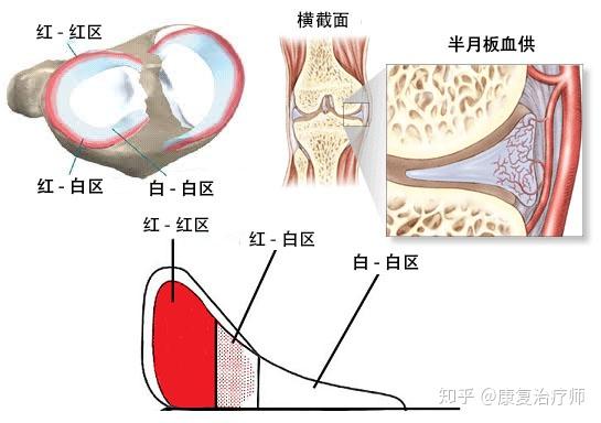 半月板损伤了 选择修复还是切除 知乎