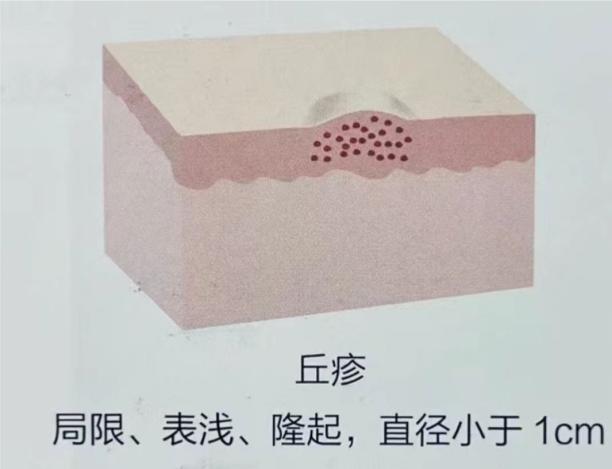 皮肤瘙痒?皮肤出现隆起?很大可能是丘疹! - 知乎
