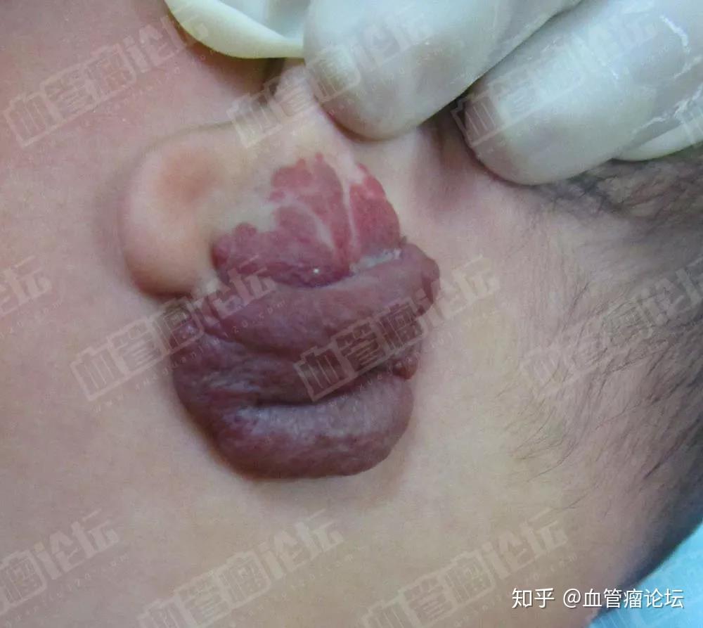 成都四个月耳部毛细血管瘤案例男童耳部毛细血管大如第三只耳朵