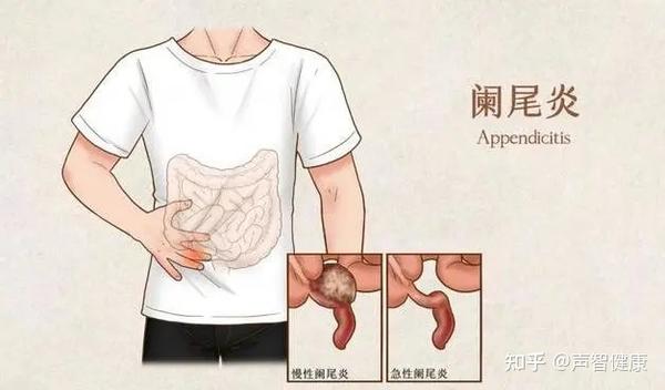 出名全靠发炎的阑尾,真的是废物吗?阑尾炎到底要不要做手术? - 知乎