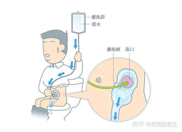 人工肛門多見於低位直腸癌根治術後,結直腸癌術後臨時造口,腸梗阻患者