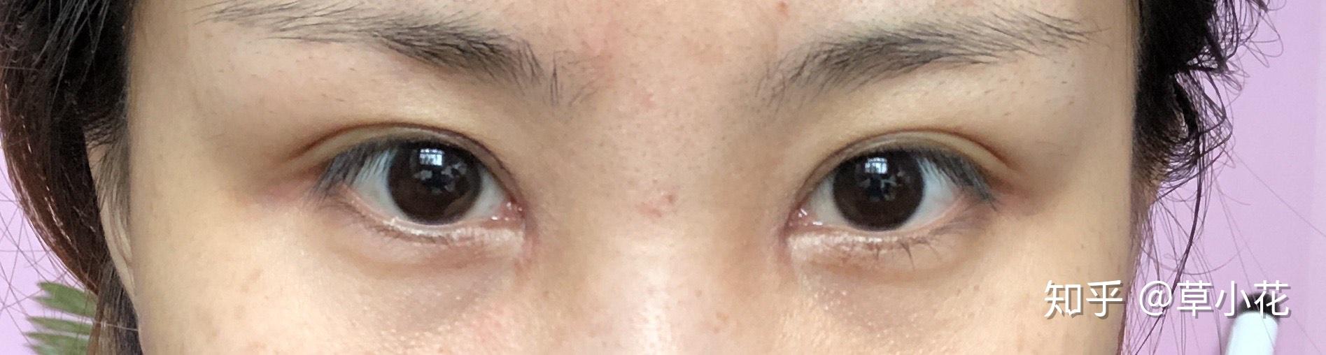 开眼角内眦赘皮记录