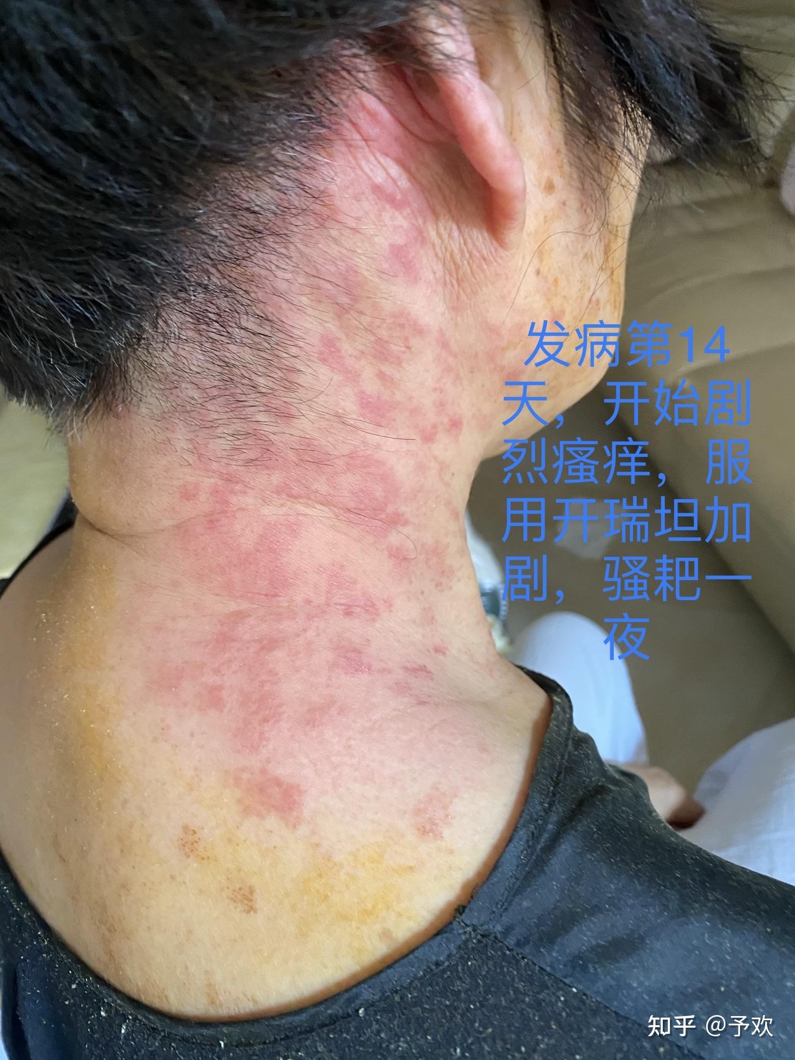 带状疱疹神经性瘙痒疼痛