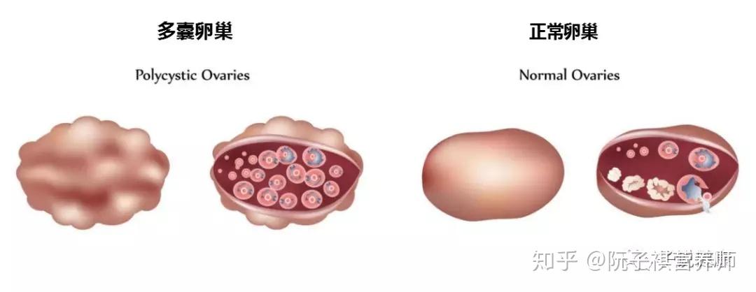 多囊卵巢综合征 (PCOS)患者最适合哪种代试管婴儿？ (多囊卵巢综合症)