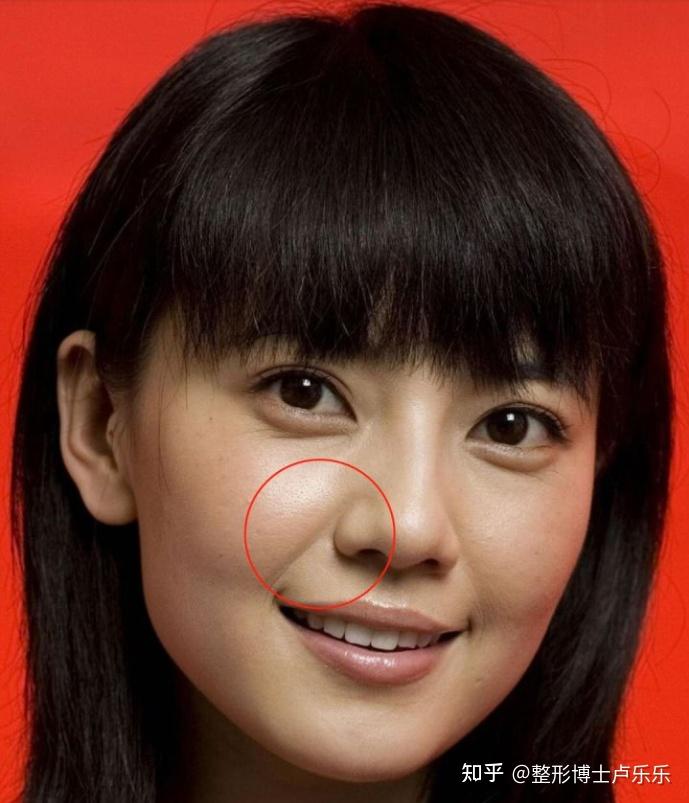 鼻基底凹陷,会造成哪些问题?