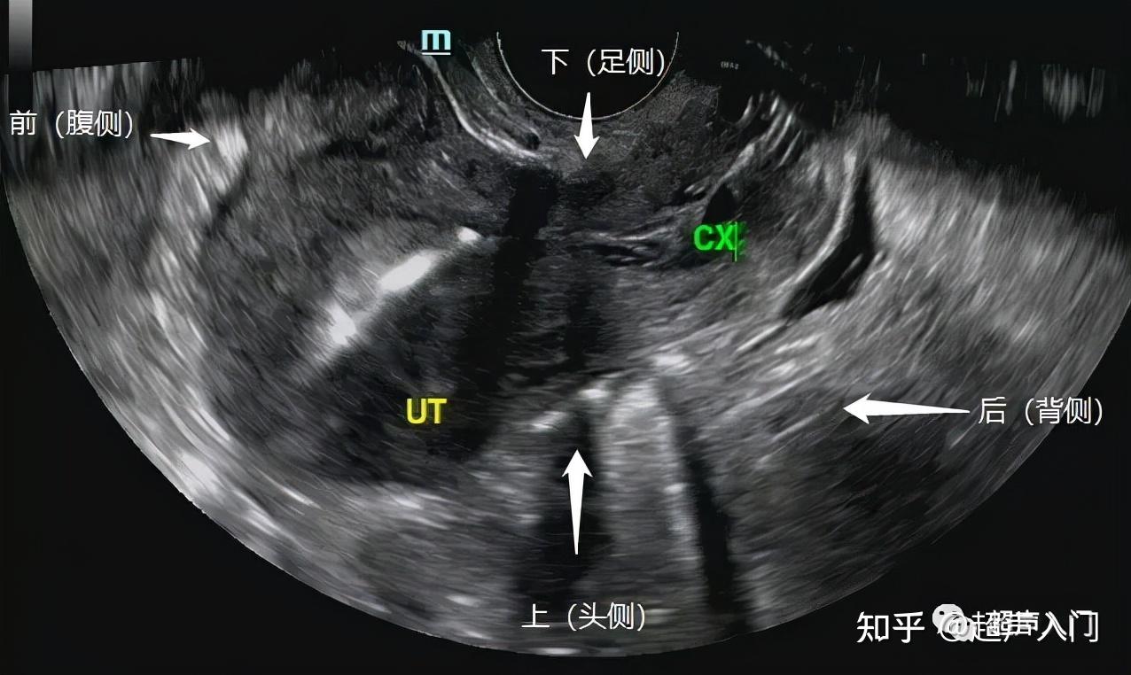 后位子宫超声图片图片