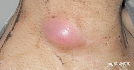 淋巴结核有脓肿,像鸡蛋般大小,红肿,看起来就像快破的