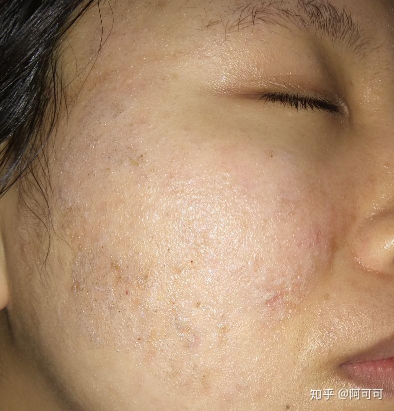 做完点阵激光第八天