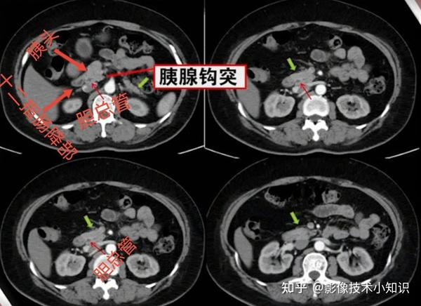 胰腺影像解剖 - 知乎