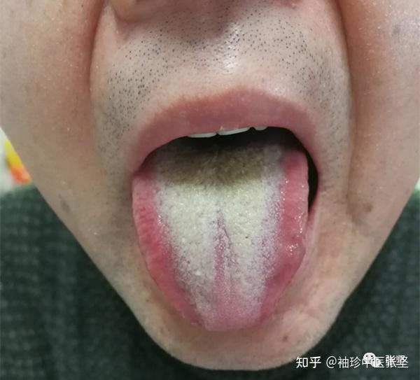(急性胆囊炎)②不仅不帮助脾胃疏泄,还要虚亢出一个股气,一股能量横逆
