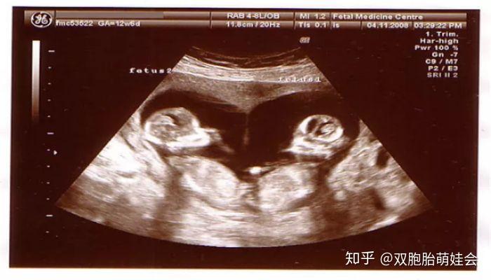 怀孕12周胎儿图片欣赏图片