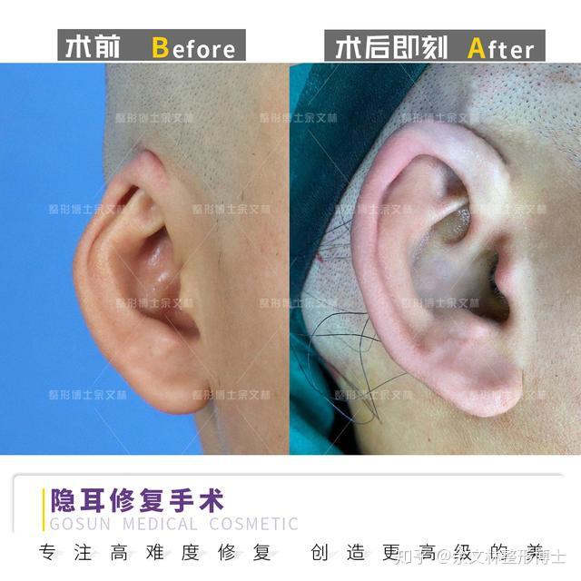 隐耳案例做了隐耳修复手术后藏起来的耳朵终于露出了真面目