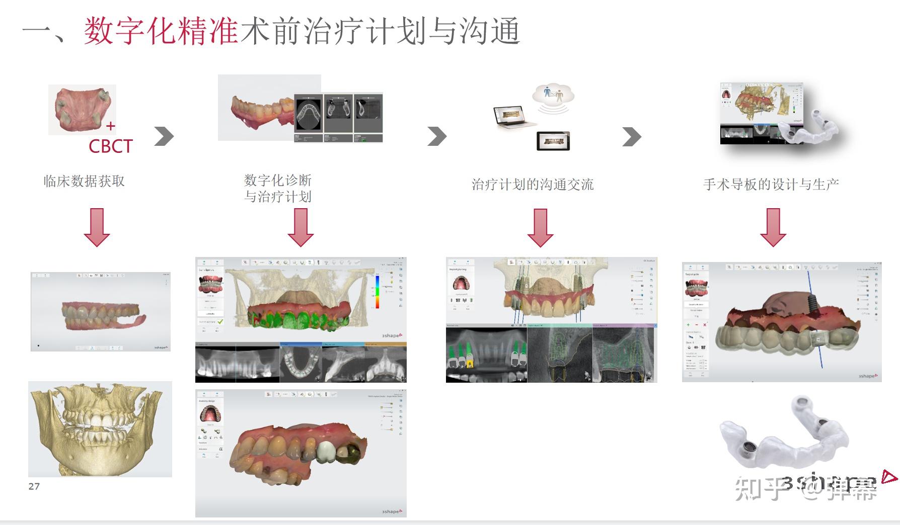 3shape口扫取模和传统取模的区别是什么?优势是什么? - 知乎