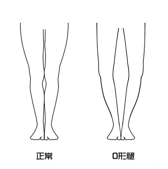 ⑤形成高低肩:前面說到長期曉二郎腿對脊柱有很大的影響.