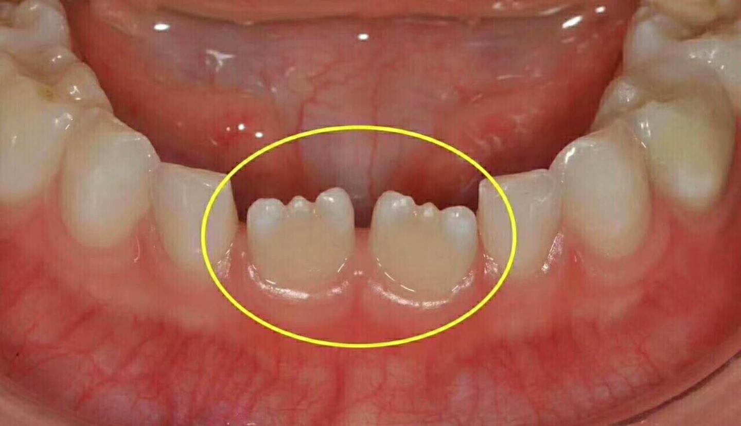 上颌侧切牙年轻恒牙牙中牙伴根尖周炎的牙髓血运重建治疗 1 例