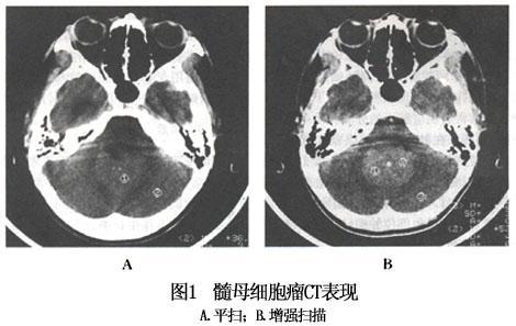 儿童最常见的恶性肿瘤,髓母细胞瘤能活多久?可以治愈吗?