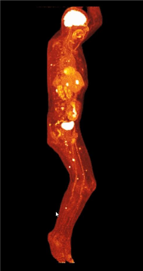什么是PET/CT？PET/CT是如何让肿瘤“无处遁形”的？这篇文章给你详细解说 - 知乎
