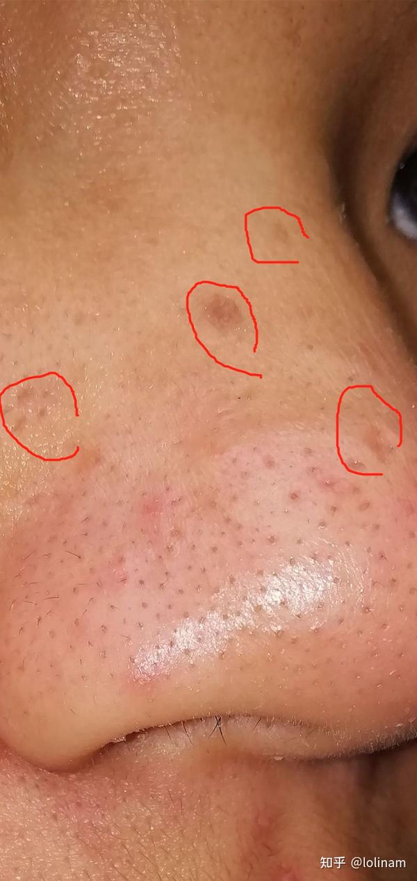 3,毛孔口黑色素沉淀以及破损