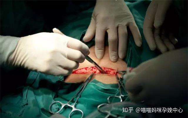 实拍剖腹产全过程照片