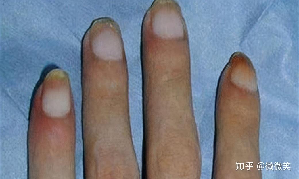 指甲发白别大意可能是肾衰竭来临