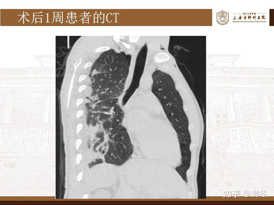 气管外伤、气管断裂——气管支气管裂伤是什么？ 如何治疗？ - 知乎