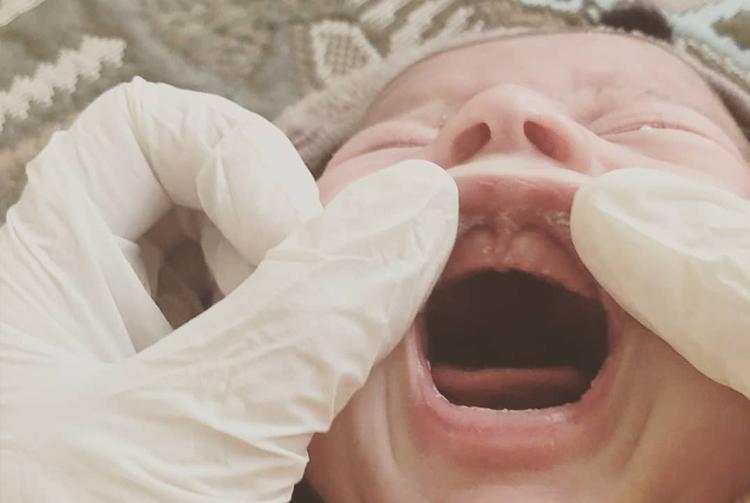 什么是张口呼吸?