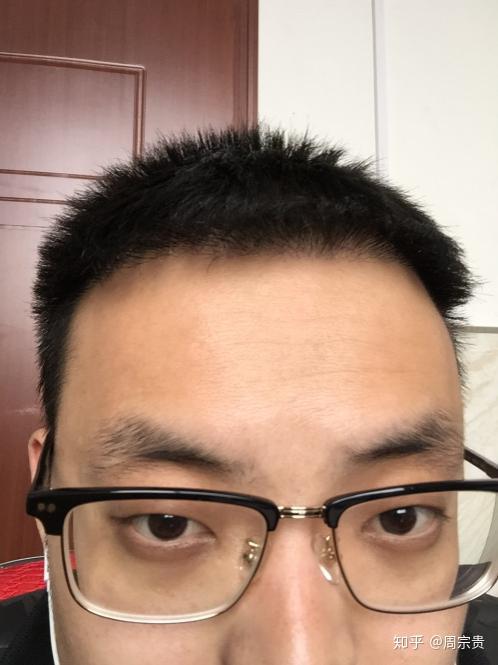 就因这两边头发很没边儿2300单位告别光秃的额角