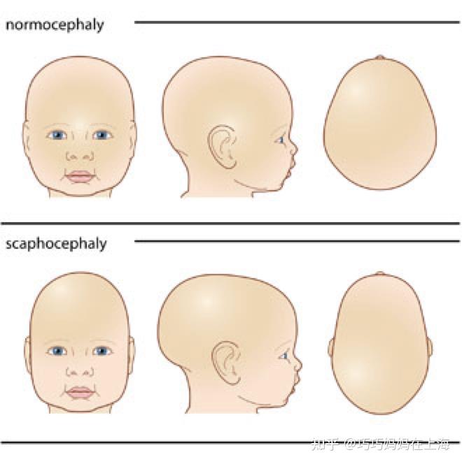 父母经常注意到婴儿头骨上的轻度畸形情况,因此自然就开始担心