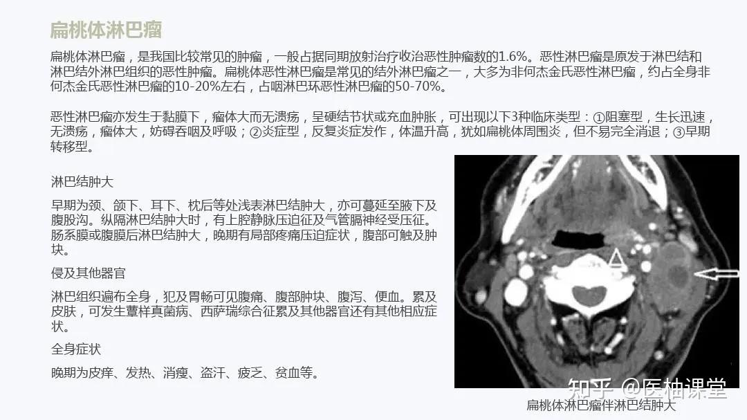 扁桃體癌扁桃體淋巴瘤和癌鑑別