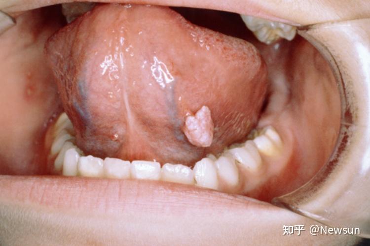 hpv感染口腔有什么症状 - 知乎