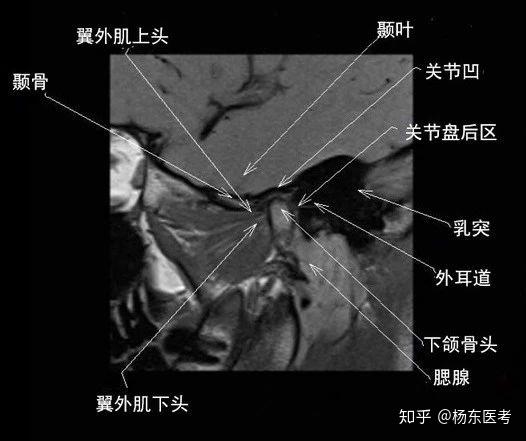 详细解剖示意图——助你理解颞下颌关节 - 知乎