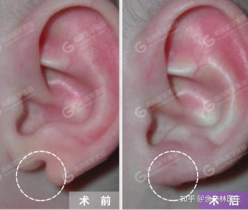 耳朵缺了一块怎么办可以修复吗