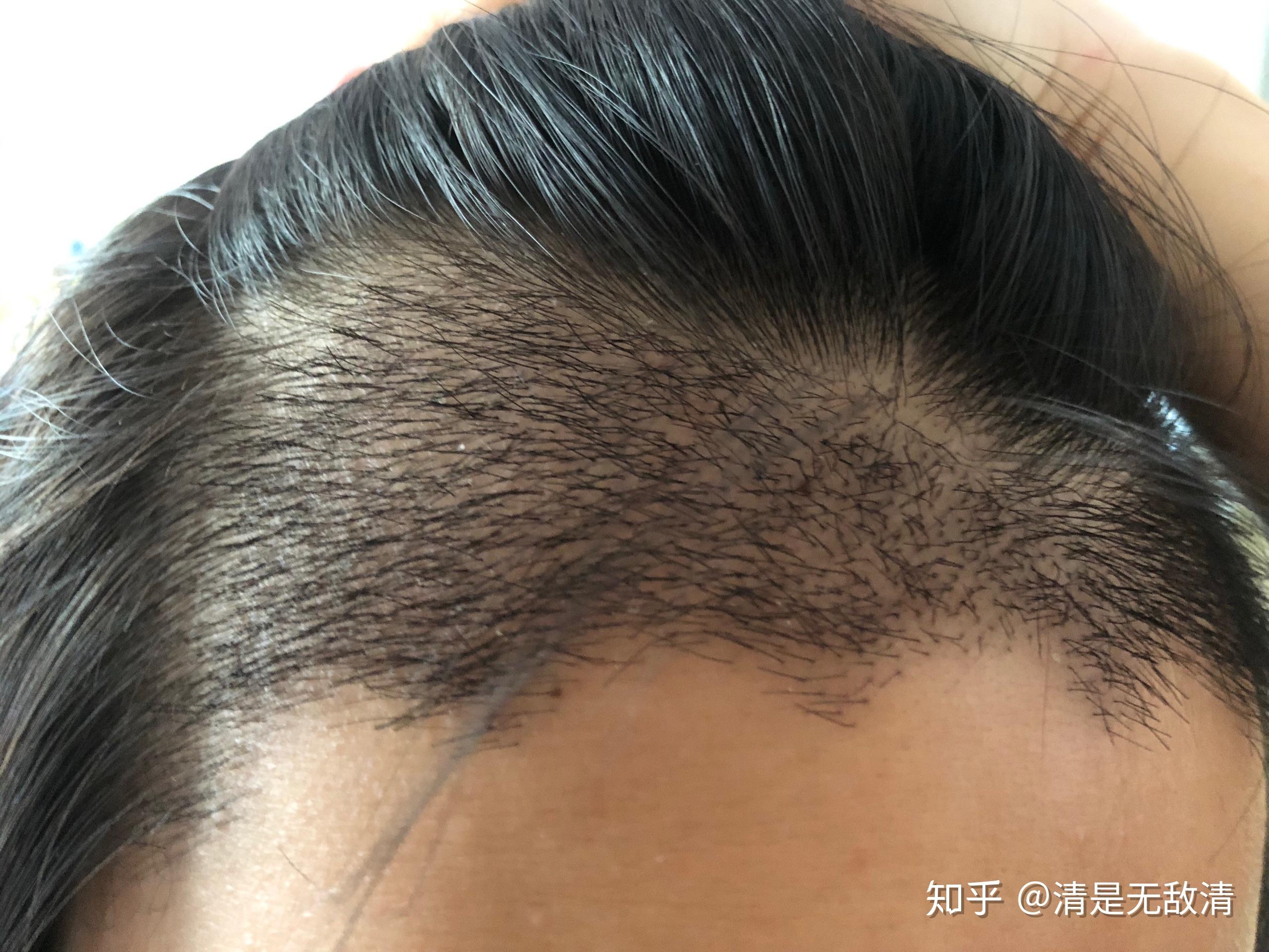 90后秃头女孩植发的经验分享帖种植发际线