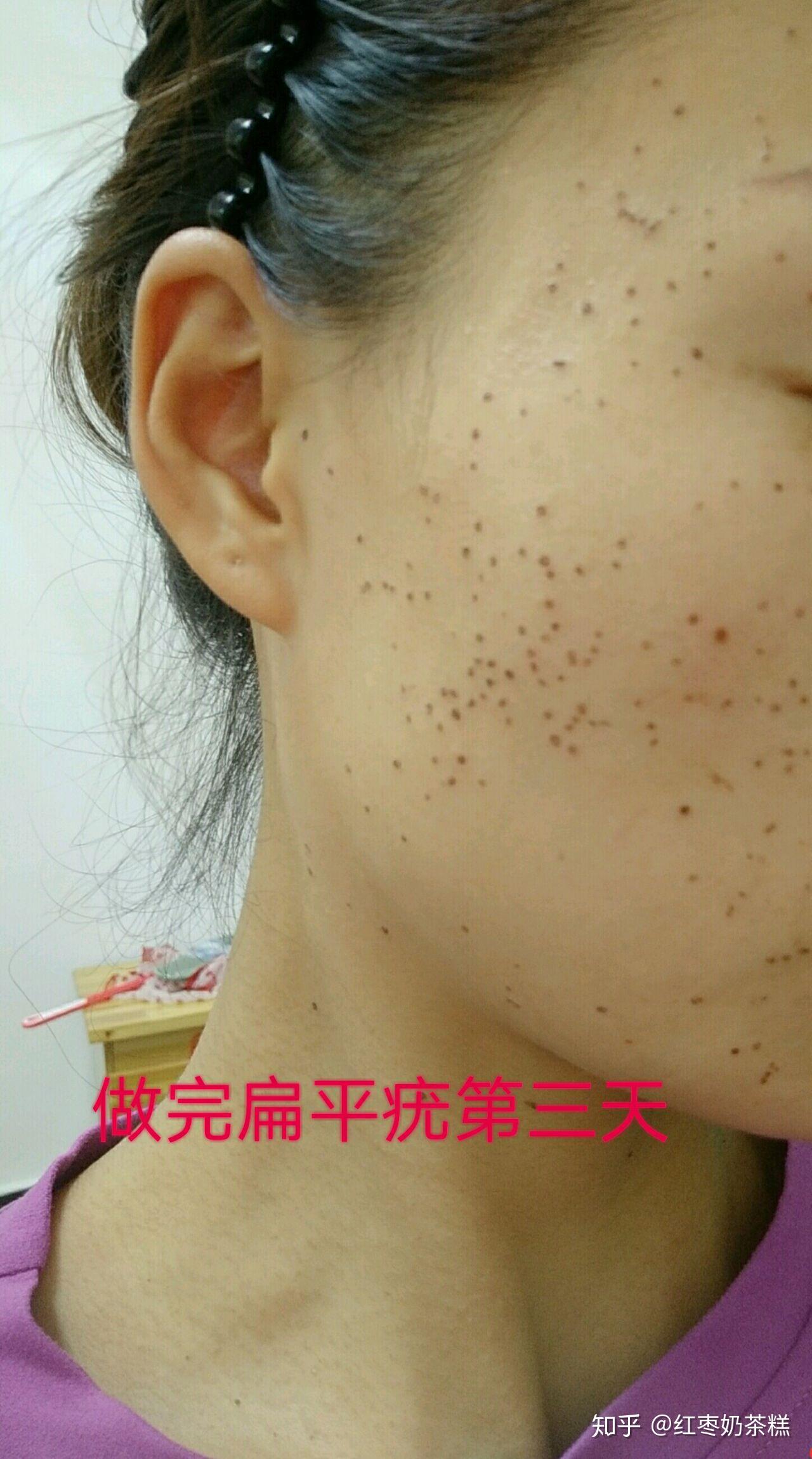 扁平疣终于治愈