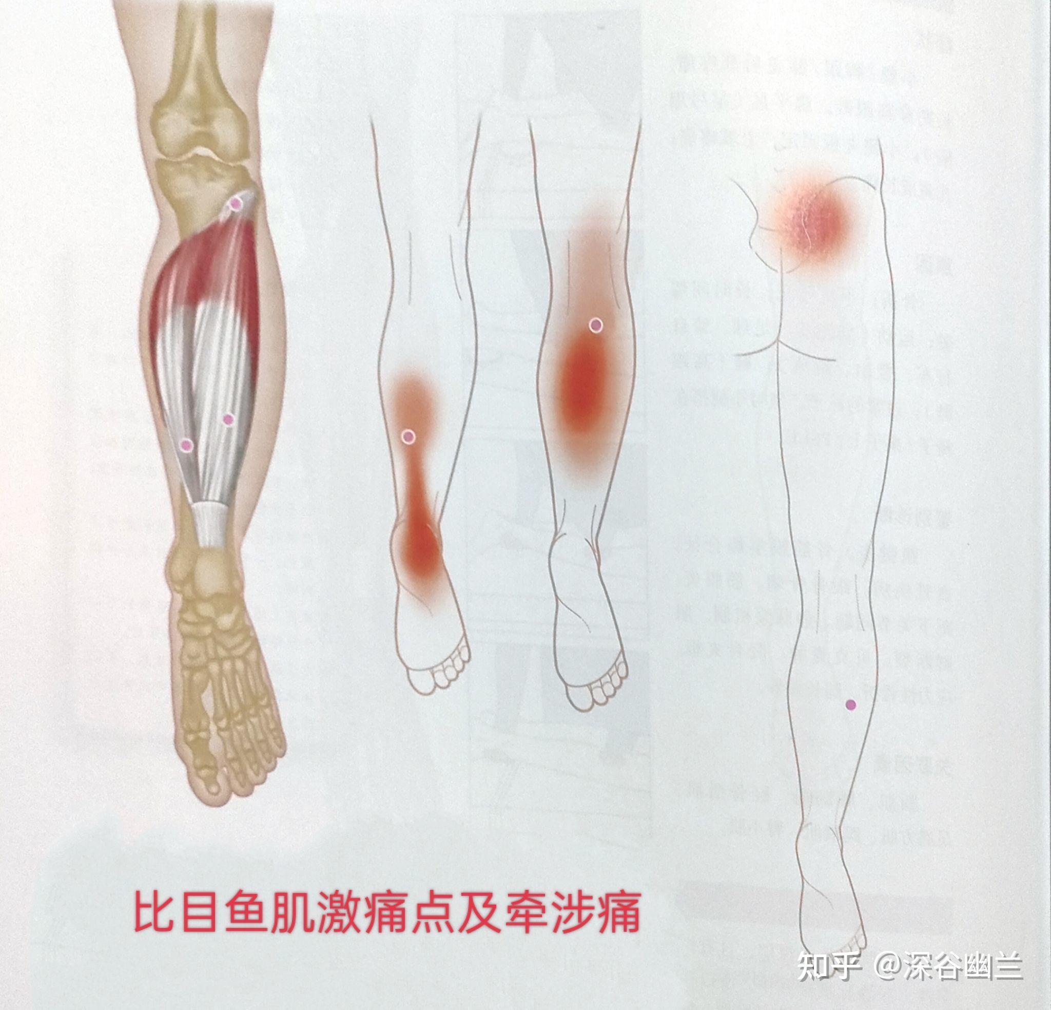 伤病丨三个足底筋膜炎及跟腱炎恢复动作_损伤