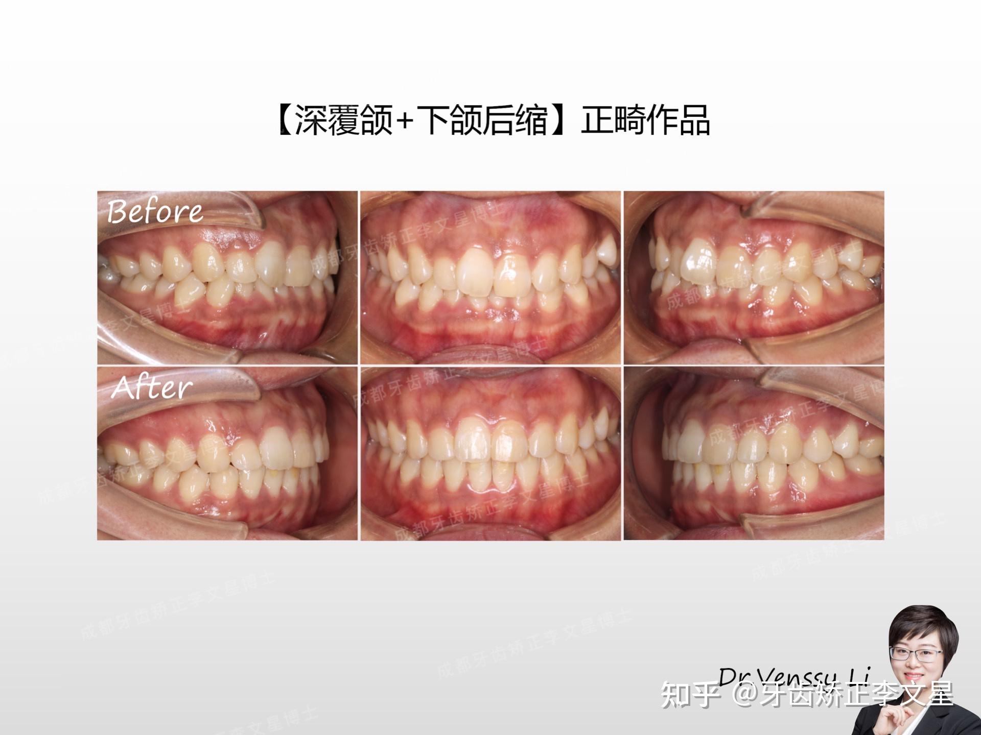 成都牙齒矯正正畸博士李文星淺談深覆合深咬合兩則案例分析