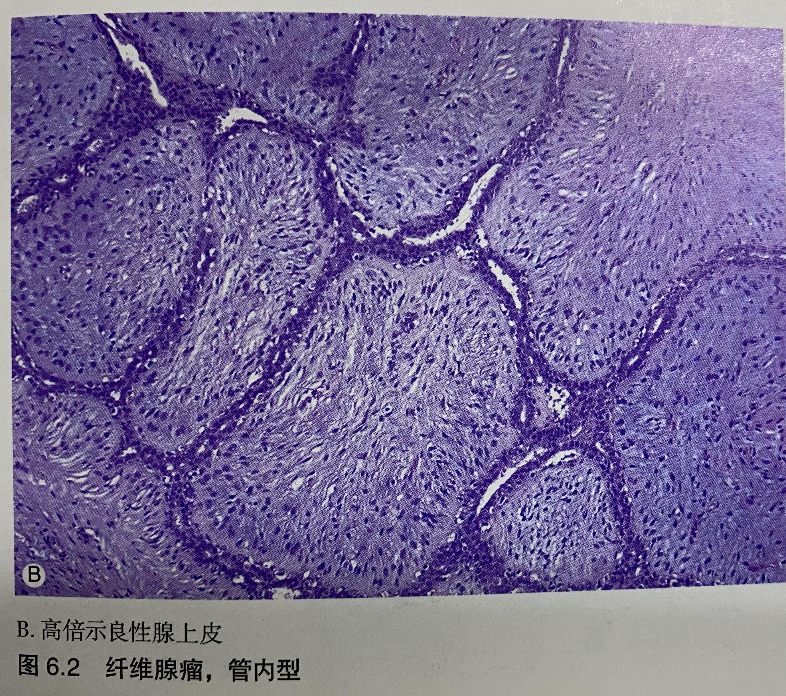 乳腺纤维腺瘤病理绘图图片