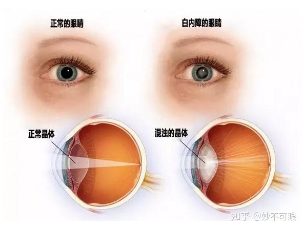 警惕儿童致盲眼病 ----先天性白内障 - 知乎
