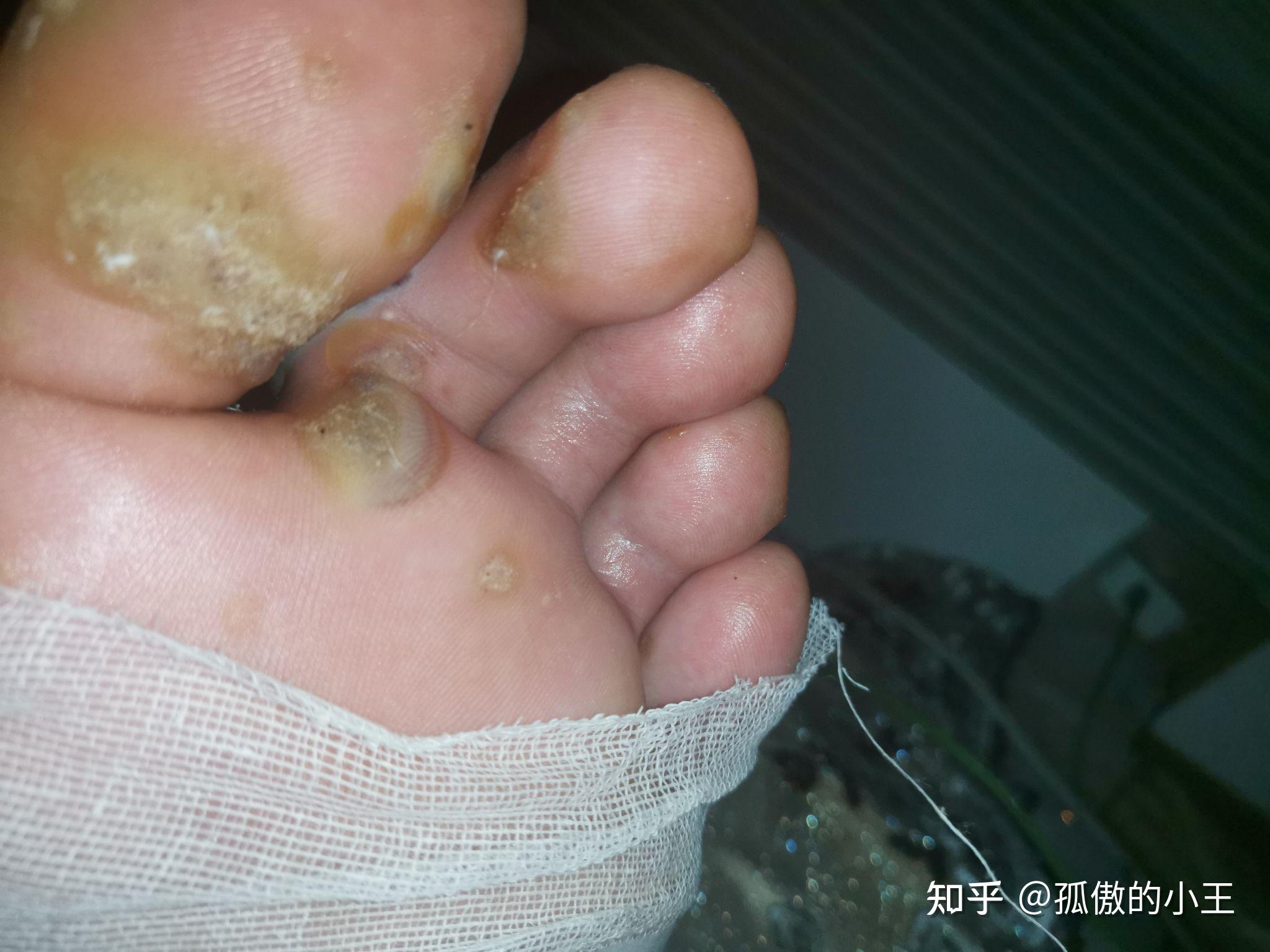 冷冻治跖疣 - 知乎