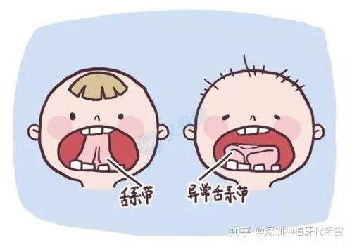 什么是舌系带短？这会有什么影响吗？该怎么判断舌系带短？孩子舌系带过短一定要剪掉吗？何时手术最好呢？ - 知乎