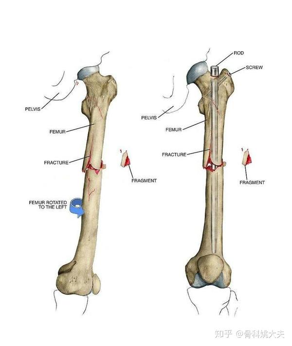 股骨骨折手术了 以后能恢复到怎么样 知乎