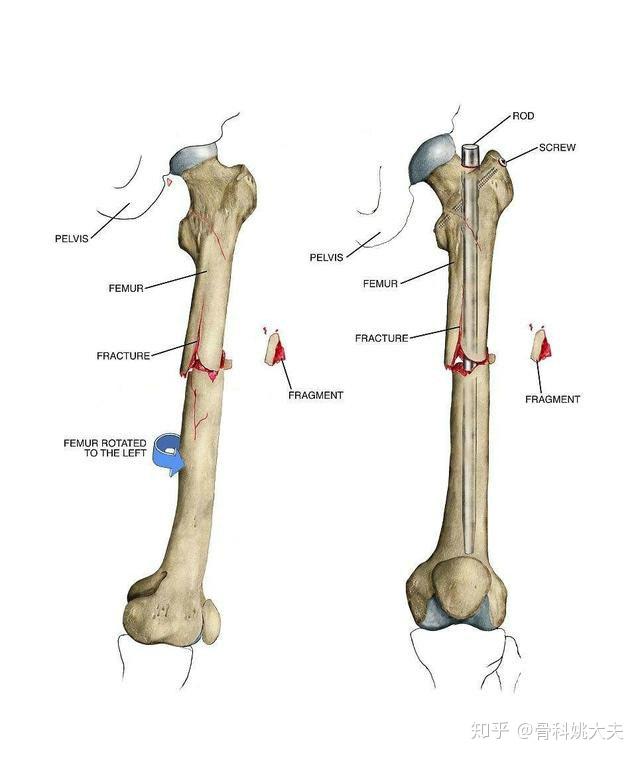 的问题,股骨骨折,我们从医学角度上讲,通常是指股骨中段的股骨干骨折
