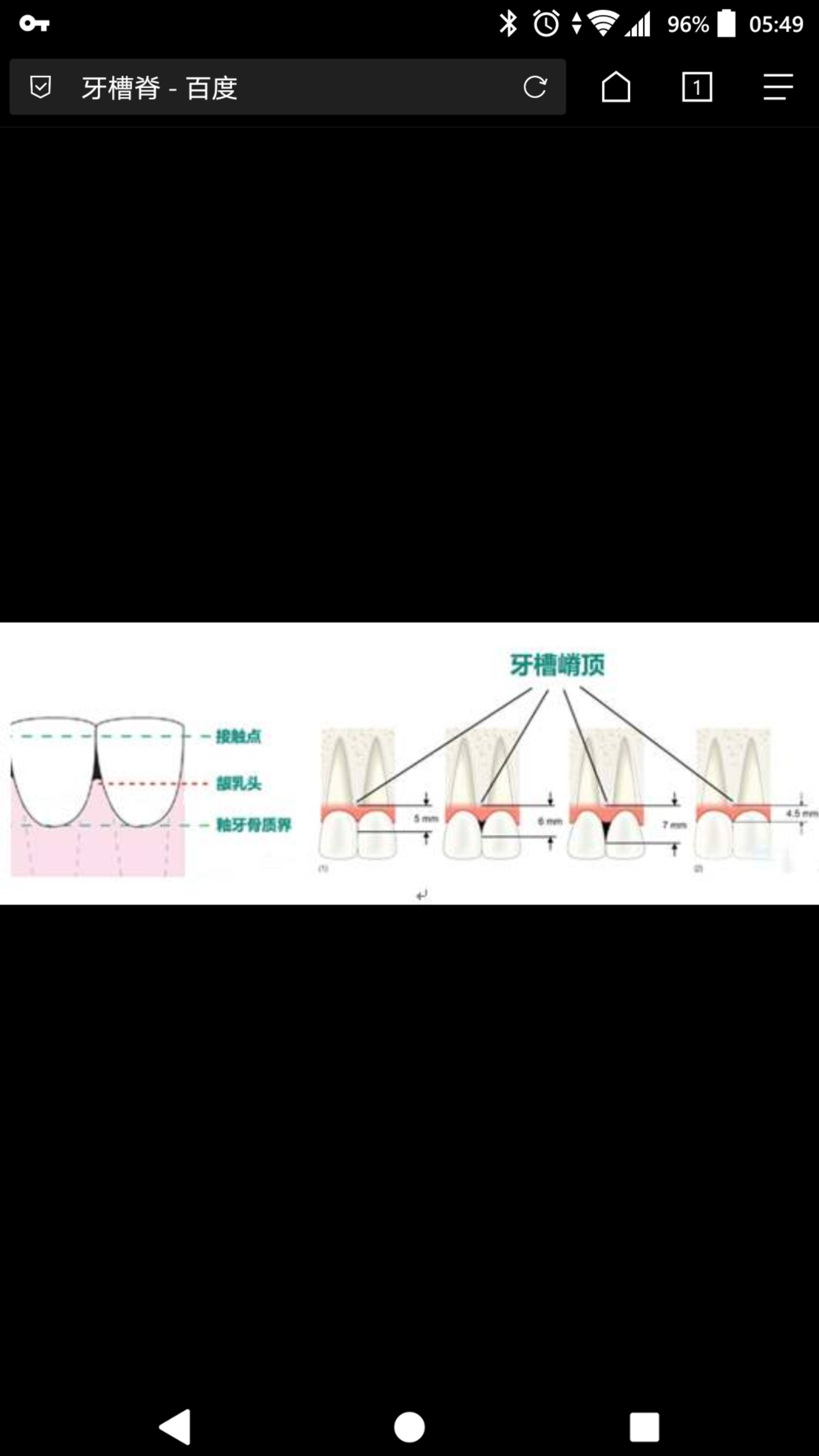 牙槽嵴名词解释图片