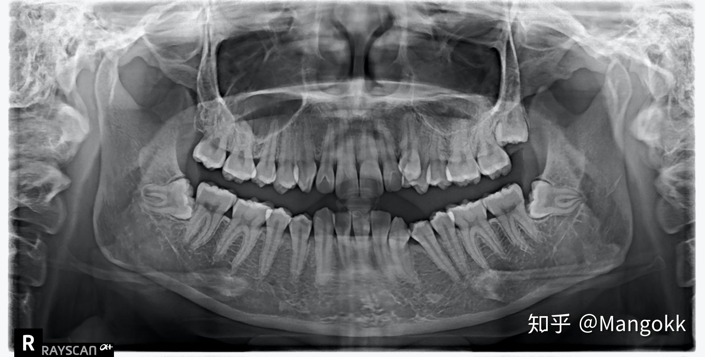 牙齿缺失是什么原因导致的呢——广州德伦口腔