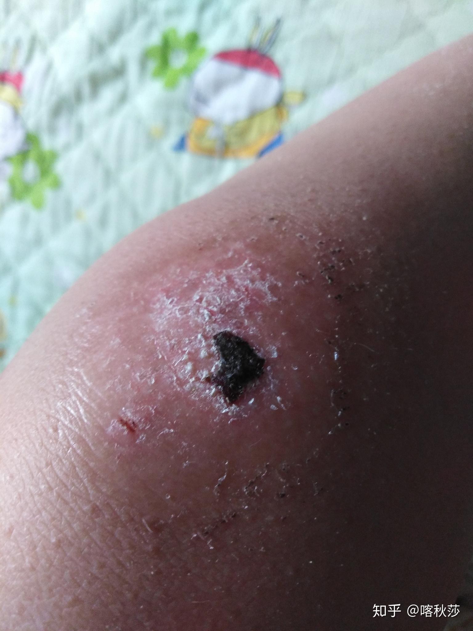 为什么喜欢把自己结的血痂抠下来然后吃了