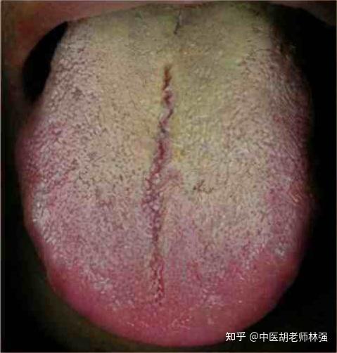 舌头边缘有齿痕?不一定是脾虚湿气重,中医教你三招解决齿痕舌 - 知乎