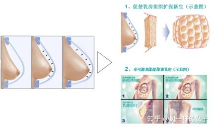 思娇丽丰胸真的靠谱吗?小白鼠的真实打卡反馈